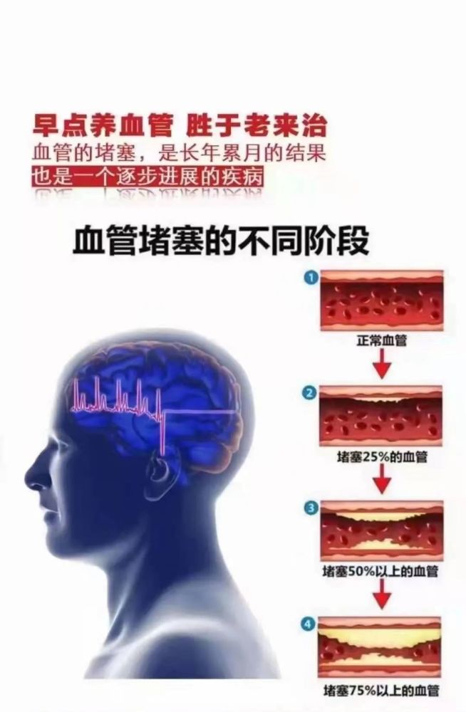 血液淤堵疾病不断三氧降脂溶栓护血管