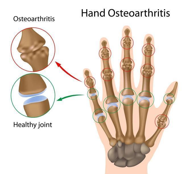 手指关节疼痛,僵硬,可能和疾病有关?看看医生怎么说