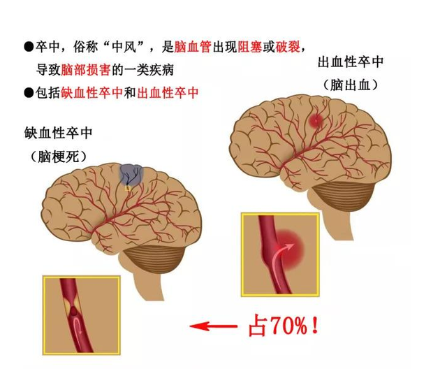 出血性卒中 腾讯网