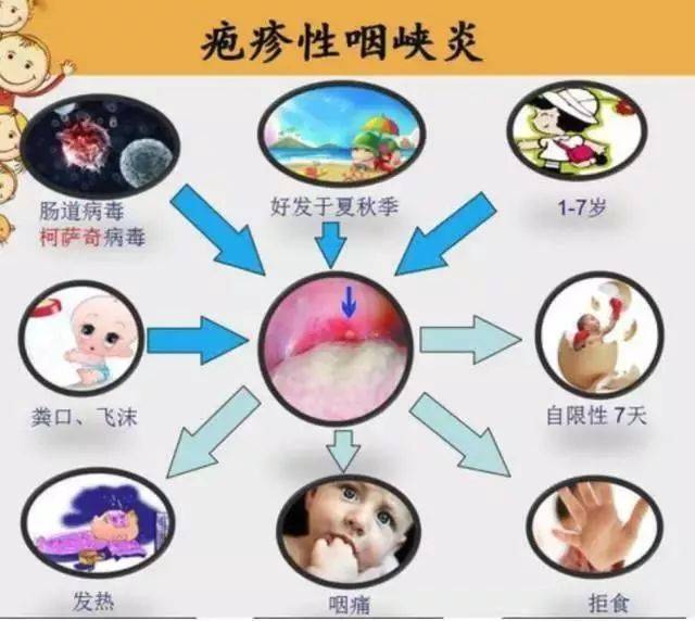 疱疹性咽峡炎的发病过程大概2周左右,分为4个不同的时期,做好对症