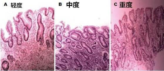 含有帕内特细胞或杯状细胞的小肠或大肠黏膜上皮组织,称为肠上皮化生