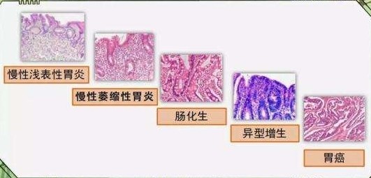 【案例】省医药院附院医生提示:胃病治疗,在于一个"早"字_腾讯新闻