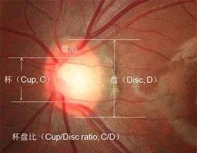 杯盘比增大了青光眼了