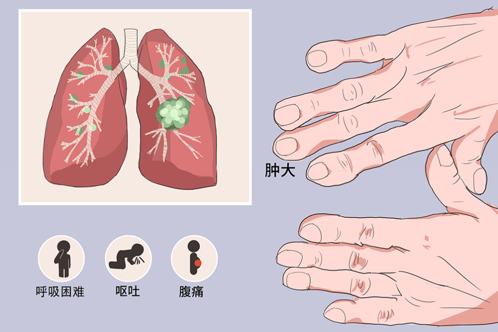 肺癌6,疼痛:罹患肺癌后,患者可以不出现胸痛,以其他部位疼痛为首要