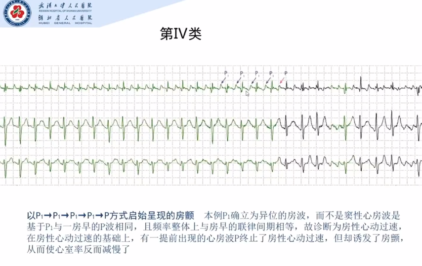 房颤发作之前,心电图是什么样的?