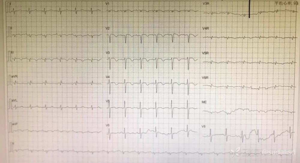 6 份有意思的 t 波倒置心电图,你能给出诊断吗?