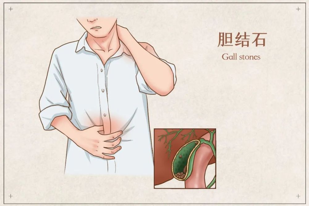 结石在胆囊内形成后,可刺激胆囊黏膜,不仅可引起胆囊的慢性炎症,而且