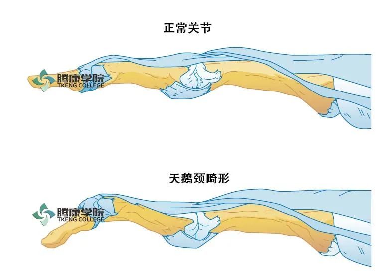 天鹅颈畸形征