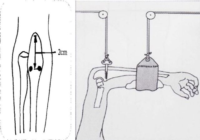 骨科小技巧尺骨鹰嘴牵引的小技巧