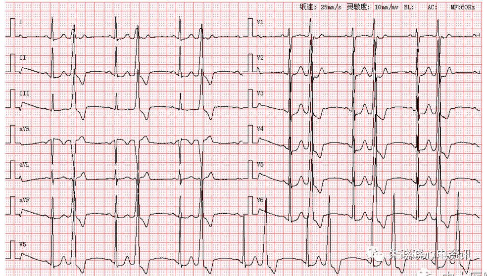 每日读图|第1404期 房扑伴三度房室传导阻滞 室性逸搏心律