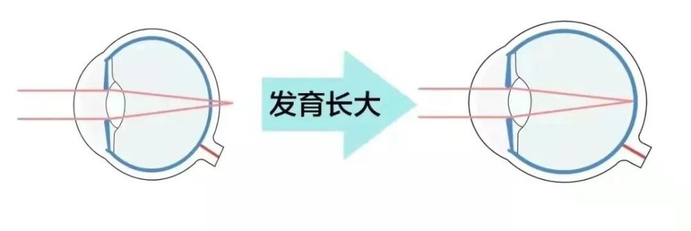 为什么要定期测眼轴?近视与眼轴生长密切相关