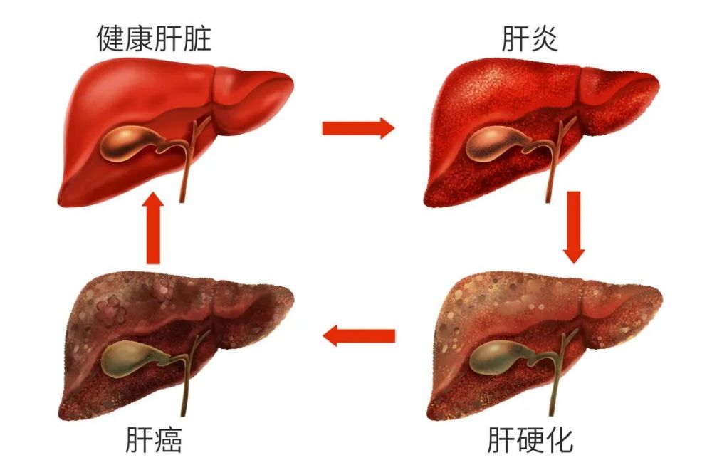 有种肝炎早期没有症状往往发现时已经肝硬化或肝癌