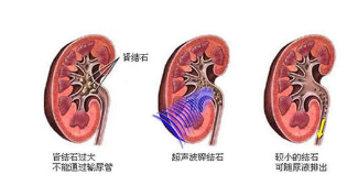 肾结石有什么症状?如何缓解疼痛?