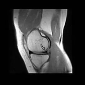 下图为内侧半月板后角内稍高信号未及关节面(Ⅱ级) Ⅲ级:半月板内高