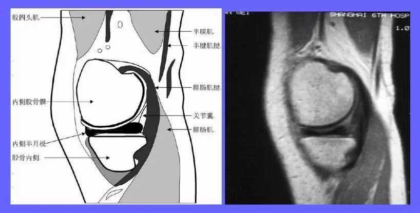 半月板损伤的mri分级及检查|骨科基础