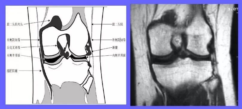半月板损伤的mri分级及检查骨科基础
