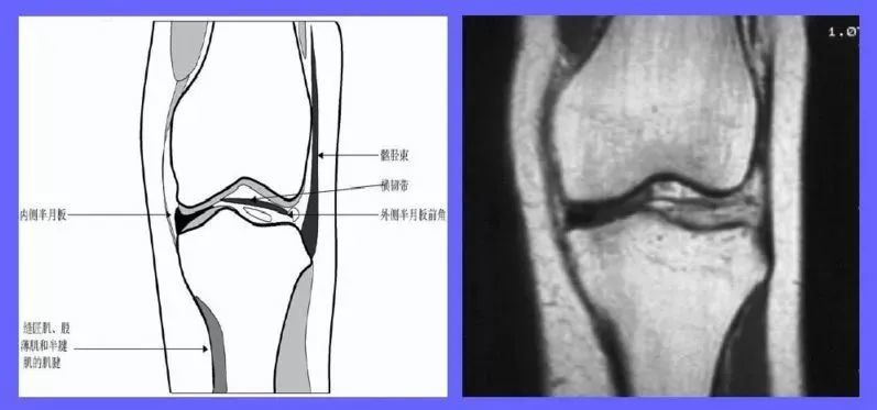 半月板损伤的mri分级及检查骨科基础