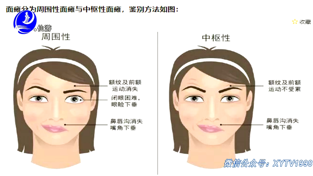 中枢性面瘫 一般在脑血管出现意外 即中风之后出现 仙游县总医院针灸