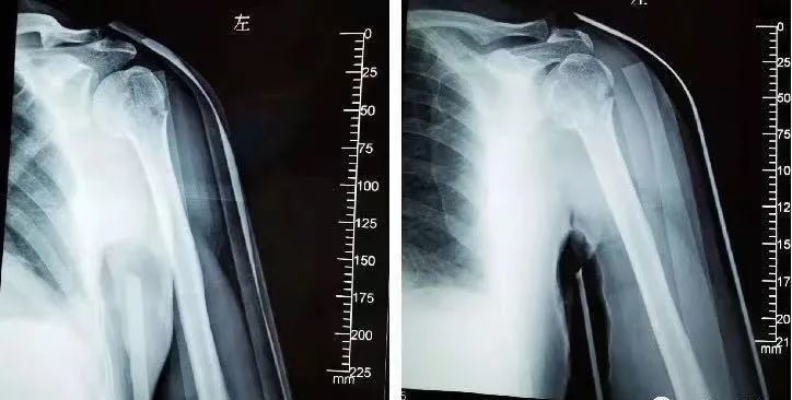 (3)肱骨大结节骨折 肩关节前脱位:受伤机制与本病相近,也表现为肩部