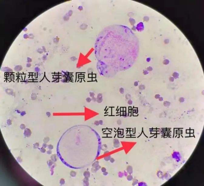 人芽囊原虫,你是夜空中最亮的星