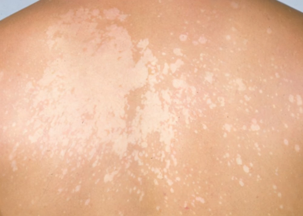 花斑癣,也称为汗斑,是一种常见的皮肤病,是由真菌剂糠秕马拉色菌引起