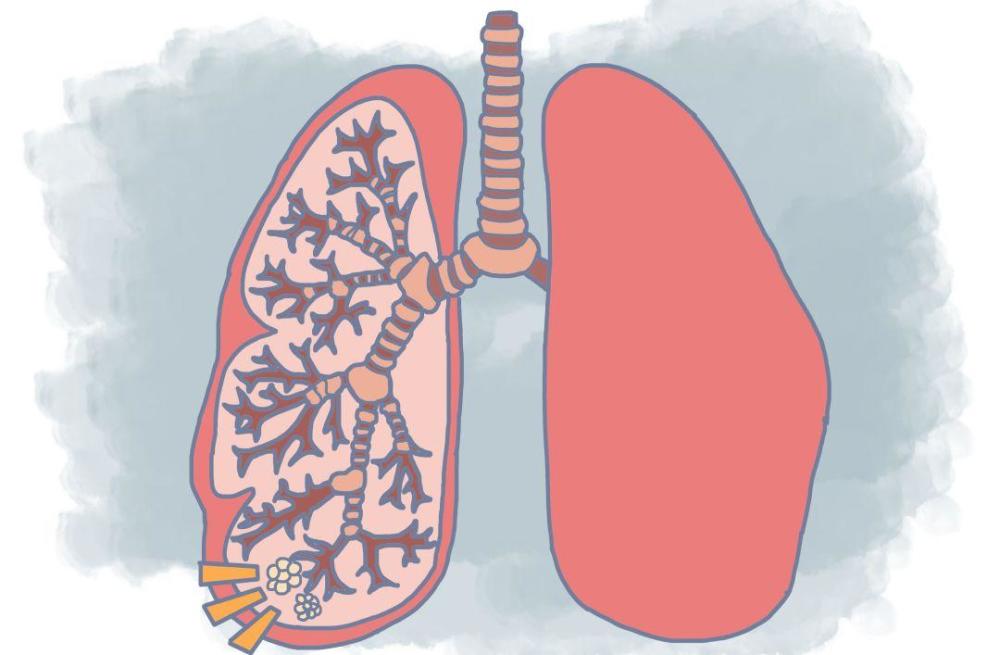 肺上有小结节是怎么回事?这4类人要注意肺部小结节盯上你