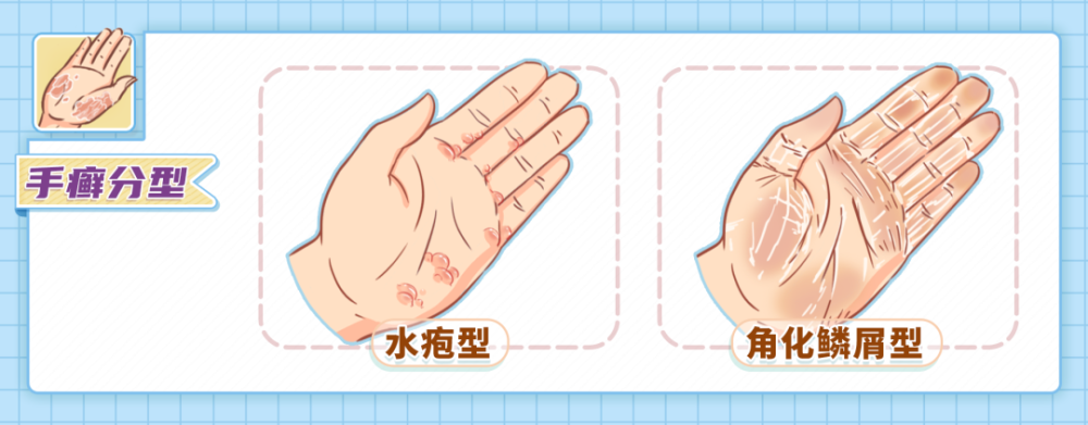 手上长小水泡,是手癣,湿疹还是汗疱疹?