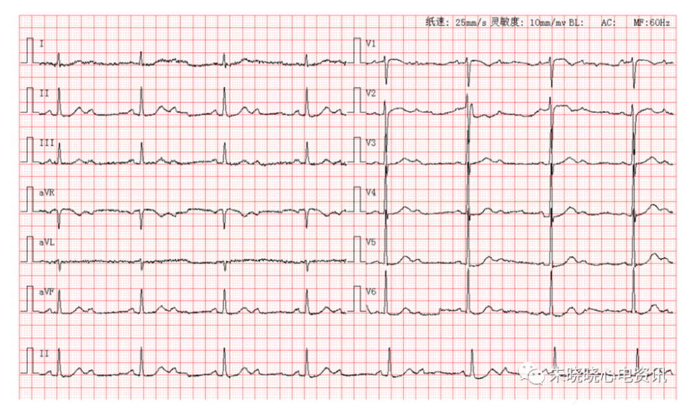 每日读图|第1408期 高度房室传导阻滞 交界性逸博心律