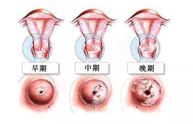 这些宫颈疾病你都要敲响警钟
