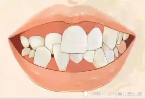 孩子12岁前必须处理的12种儿童牙颌畸形问题