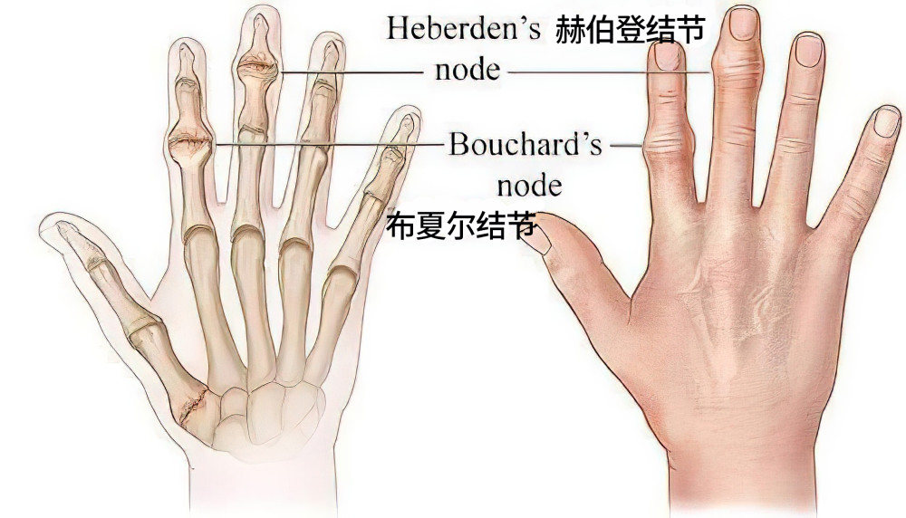 间关节的赫伯登(heberden)结节和近端指间关节的布夏尔(bouchard)结节