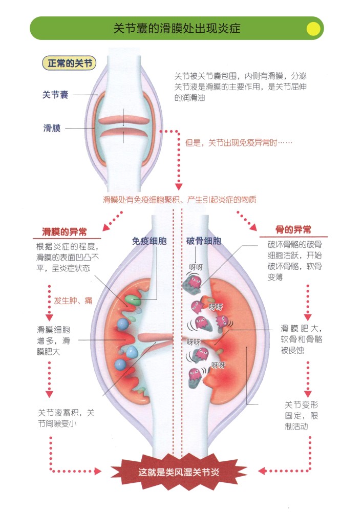 类风湿关节炎,是风湿免疫性疾病中最常见的一种,它的发病机制还不完全