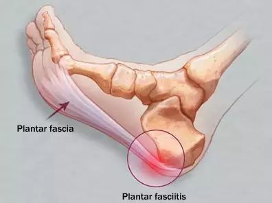 足底筋膜炎(足跟到脚尖的肌腱,韧带的细微撕裂或炎症)常常是跑步者最
