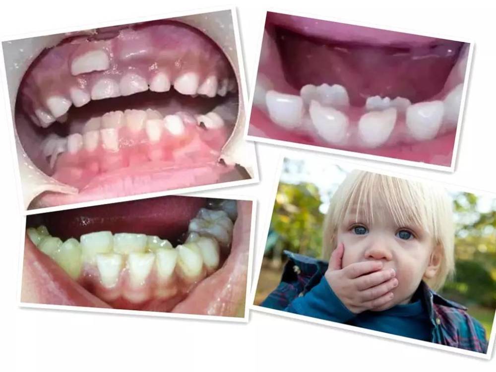 孩子乳牙滞留有什么危害,如何预防?
