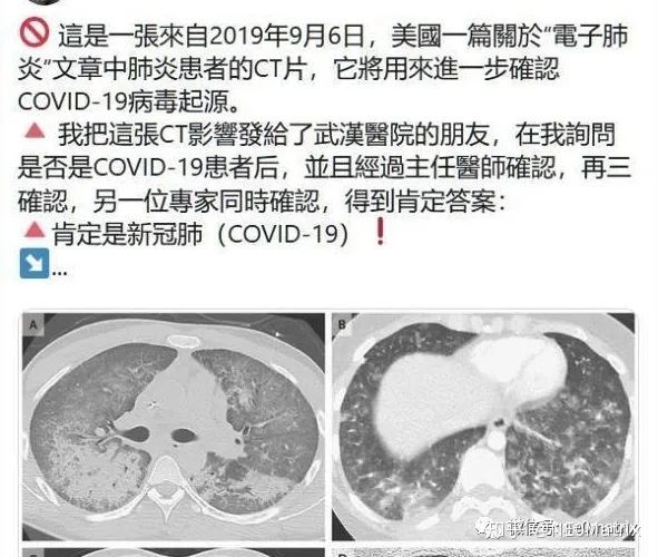 肺炎患者的肺部ct部分区域呈现 团状模糊的白色,所呈现的"大白肺"与新