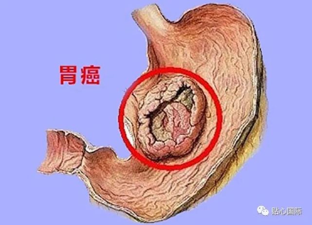 专家指出,早期胃癌80%没有症状,少数有症状的也是些非典型症状,极易同