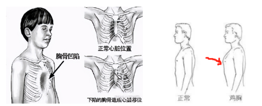 漏斗胸(pectus excavatum,pe)是临床上常见的以胸壁凹陷为主要特征的