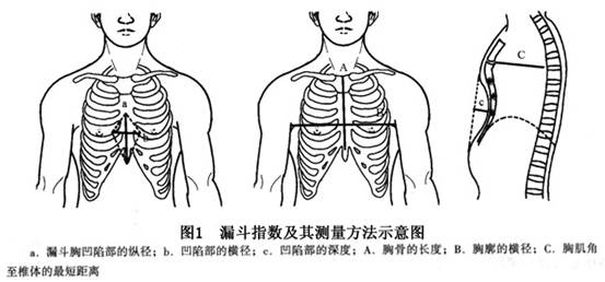 1)患者的胸壁呈明显的漏斗形,胸壁凹陷的深度>2cm.