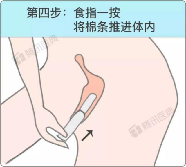 放棉条:食指慢慢把导管另一端的活动头按下去,最后再把外导管拉出来就