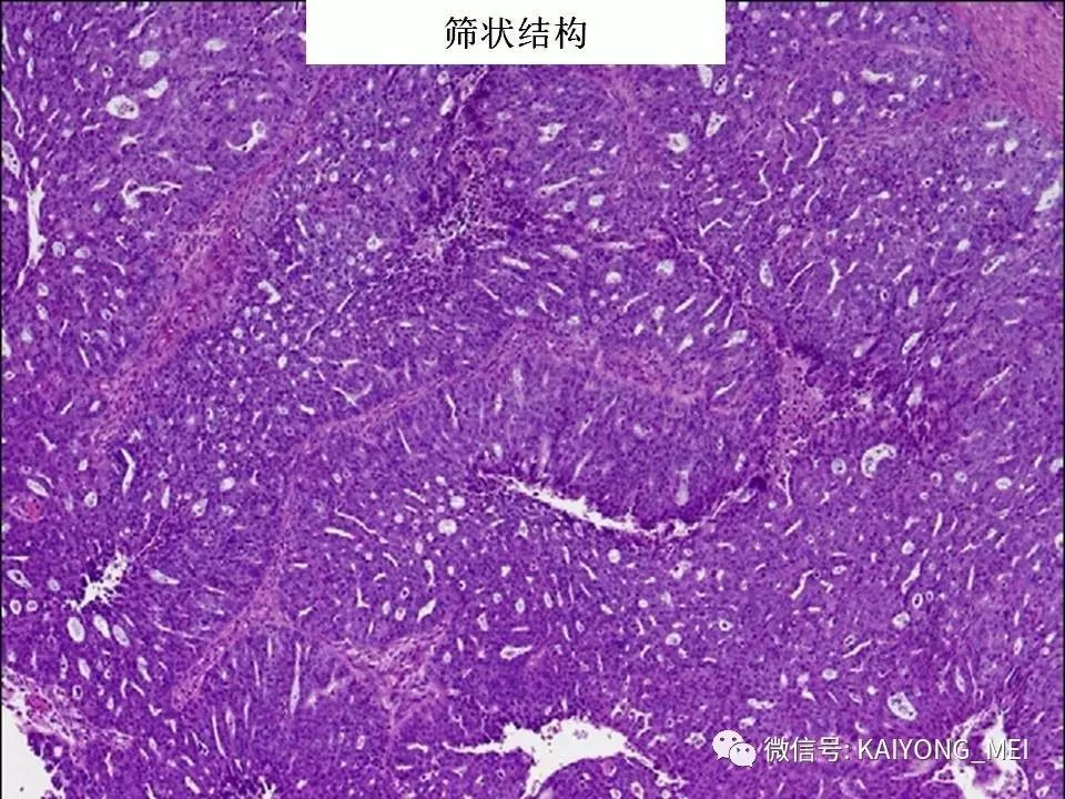 卵巢癌的病理诊断新进展(一)