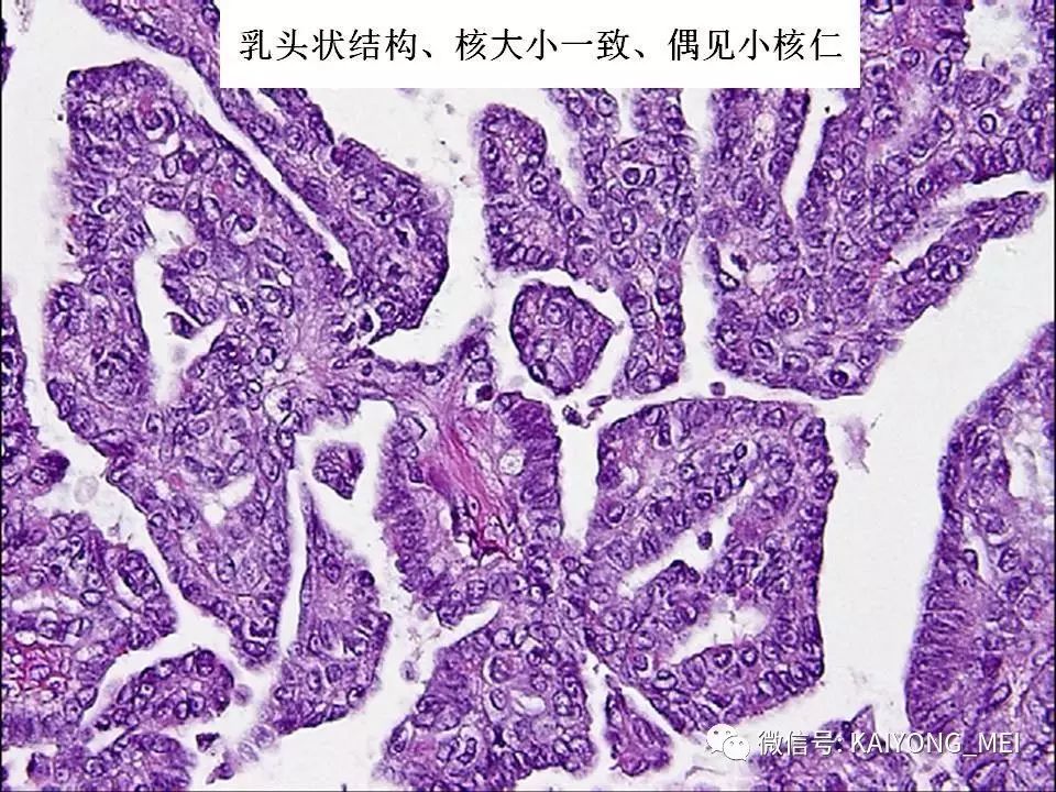 卵巢癌的病理诊断新进展(一)