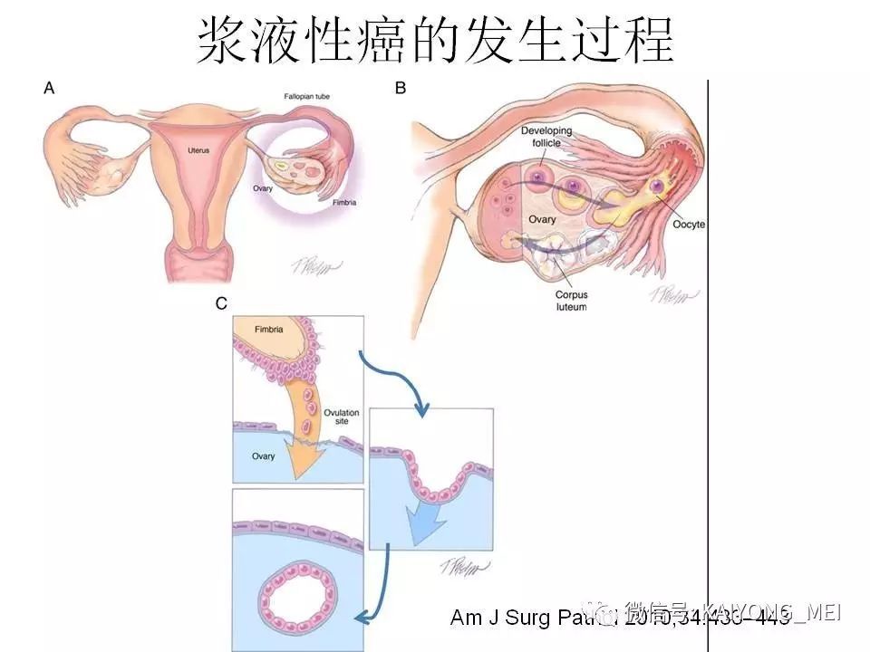 卵巢癌的病理诊断新进展(一)