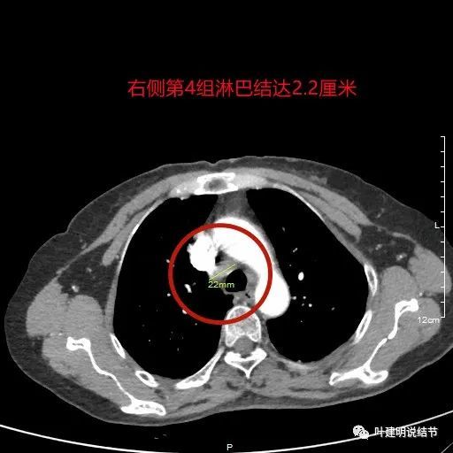 右上纵隔淋巴结肿大,达1.8厘米