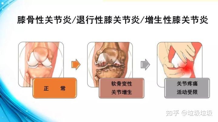 韧带松弛,关节不稳,肌力减弱等,由于骨骼承受的压力增大,受力不均