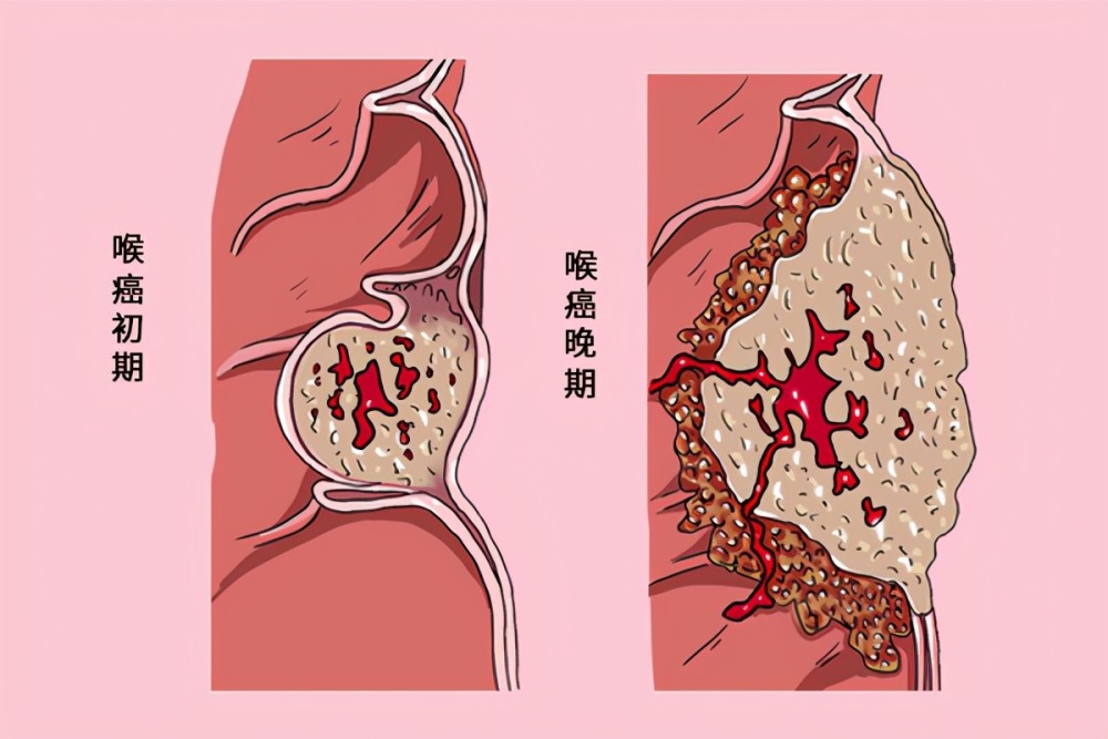 咽炎和喉癌有什么区别?hpv病毒,也会诱发喉癌?