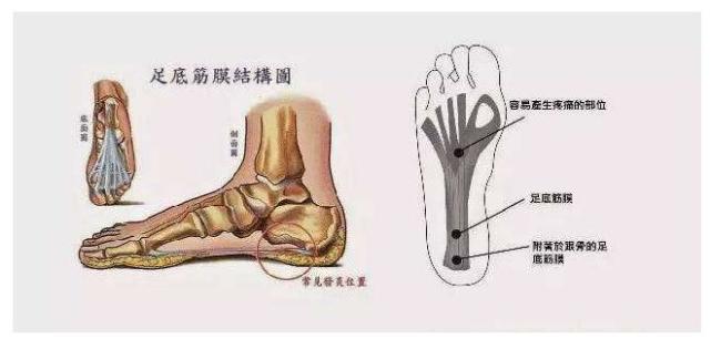 脚底筋膜炎症状|足底筋膜炎|症状|足底