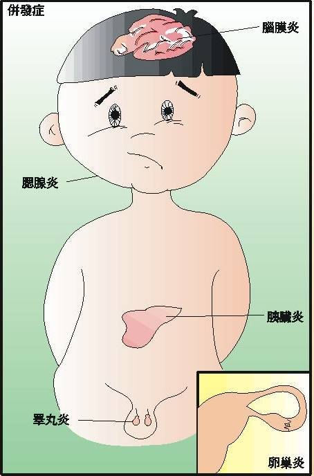 腮腺炎还会引发不育?