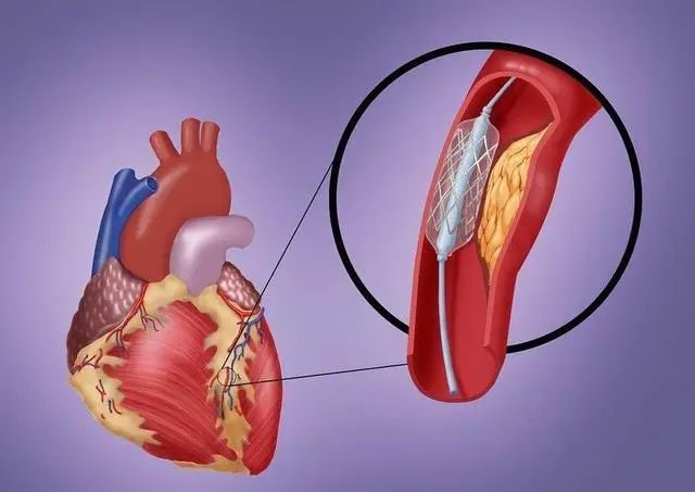 一分钟讲明白心脏搭桥支架分别是咋回事