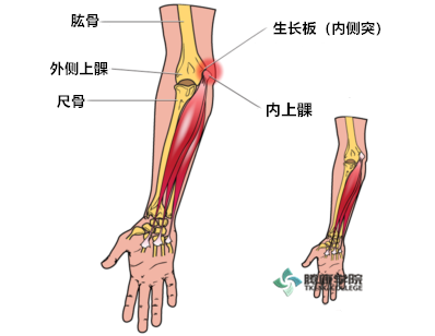 棒球肘诊疗分析与运动康复肱骨内上髁撕脱骨折