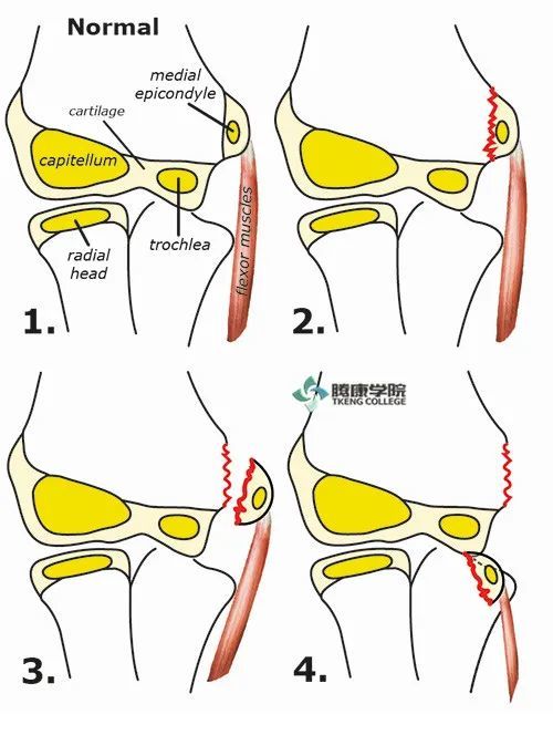 棒球肘诊疗分析与运动康复肱骨内上髁撕脱骨折